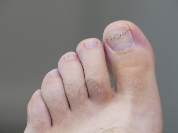 orthèse ongle pied